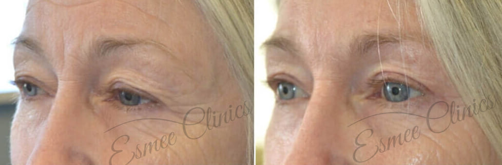 Before and After img